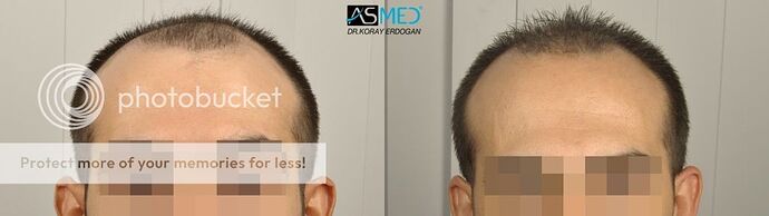 Dr Koray Erdogan, ASMED Clinic - Twin brothers' operations - 3200 grafts FUE / 4300 grafts FUE photo