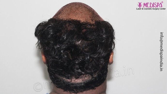 Dr. Suneet Soni - 4500 Grafts, 3 Year Result, NW-IV, Combine FUT + FUE Technique photo