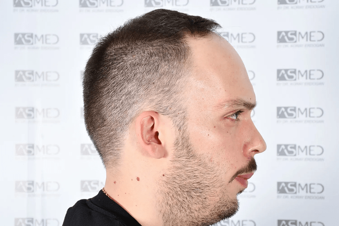ASMED, Istanbul: 5,071 Manual FUE Grafts 0/12 Months photo