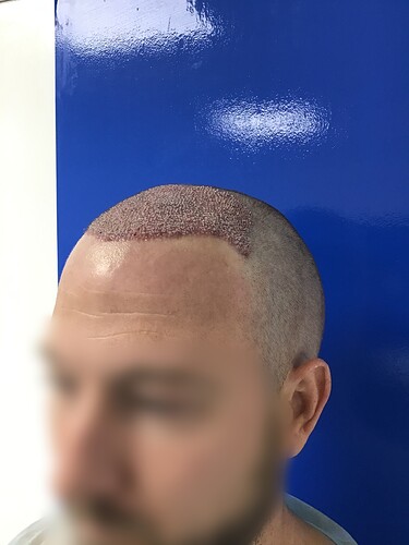 Dr.Bisanga, BHR Clinic Brussels 3251 FUE 0 - 8 Months photo