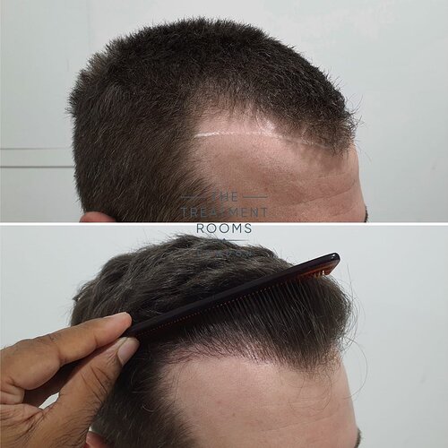 1297 Grafts- FUE Hair Transplant- The Treatment Rooms London photo