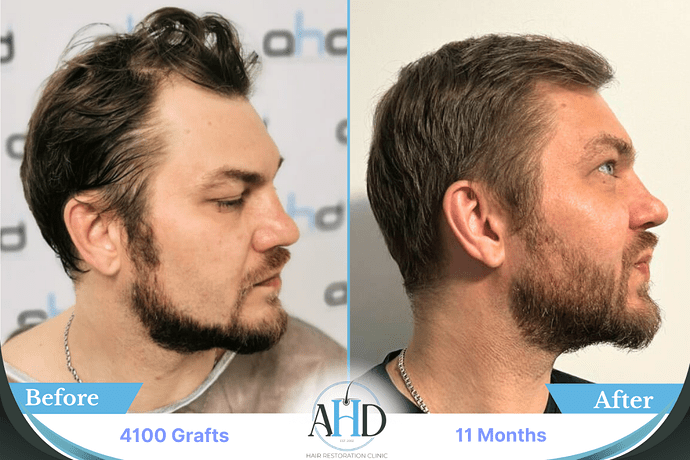 AHD Clinic Turkey - Hair Transplant Before & After Pictures - 4100 grafts - DHI photo