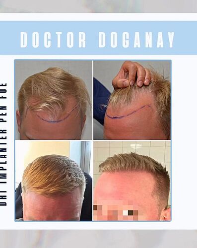 DR HAKAN DOGANAY/ 3000 GRAFTS / Implanter Pen+FUE photo