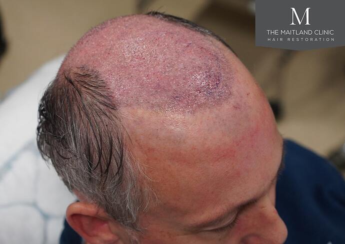 Dr Ball - The Maitland Clinic 2448 Grafts By FUT photo