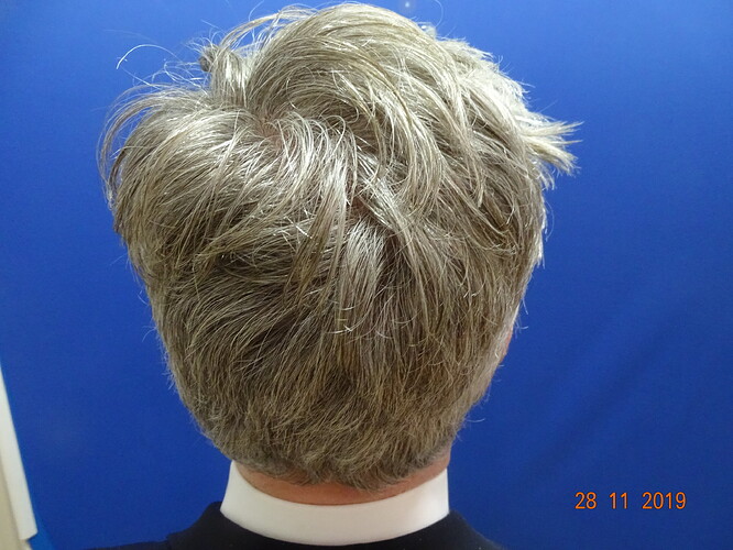 Dr. Bisanga - BHR Clinic - 2180 FUE Repair 0 - 17 Months - Graft Removal and Hairline Reconstruction photo