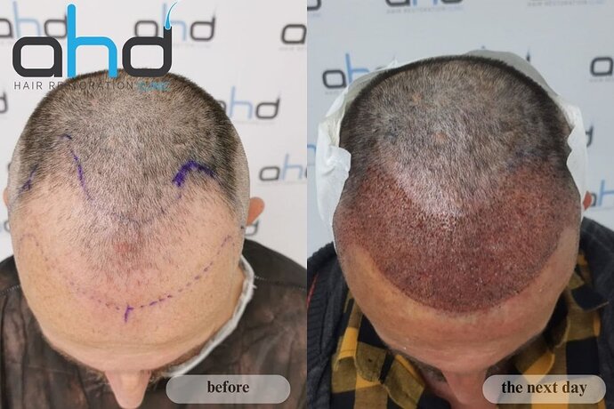 AHD Clinic / Dr.Hakan Doganay's Team / DHI + FUE/ 3500 grafts photo