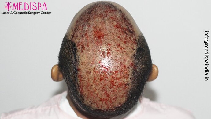 Dr. Suneet Soni - 5294 Grafts, Combine FUT + FUE + Beard Technique, NW- VI, 2 Years Result photo