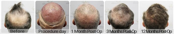 Dr Bonaros, Glasgow, UK / 3986 FUE grafts / 0-12 Months photo
