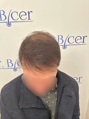 Ozlem Bicer MD-Hair Transplant-3980 Grafts FUE by micro-motor, 12. months result photo