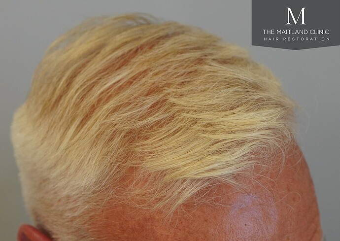 Dr Ball - The Maitland Clinic 2280 Grafts by FUE photo