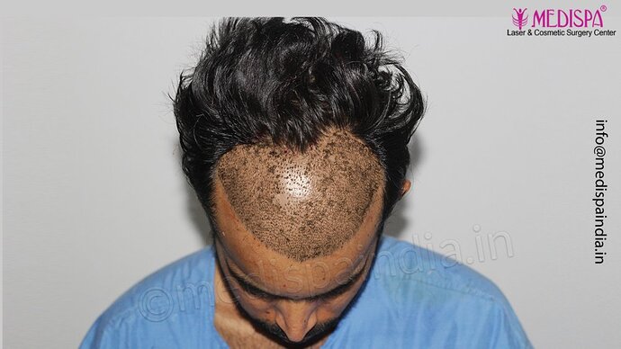 Dr. Suneet Soni - 3029 FUE Grafts, FUE Method (Trivellini System), NW - III photo