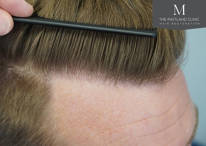 Dr Ball - The Maitland Clinic 1204 Grafts By FUE photo