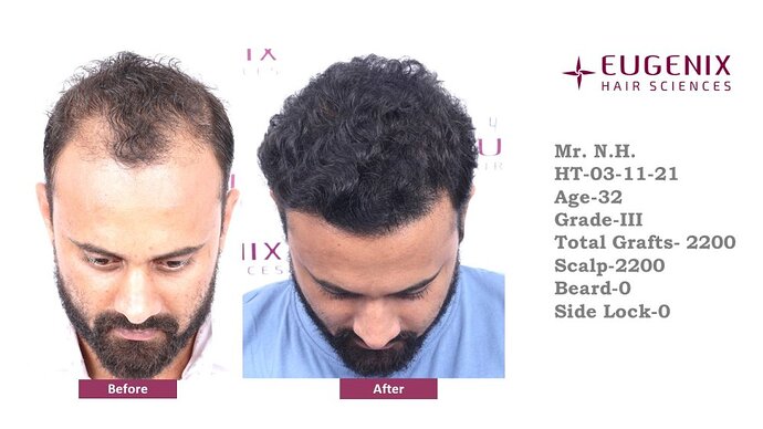 Eugenix Hair Sciences Clinic | Norwood Grade 3 | 22 Months Hair Transplant Results| photo