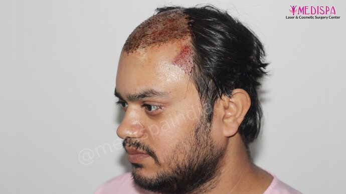 Dr. Suneet Soni - 4937 Grafts, Combine FUT + FUE Technique, NW : IV-V photo