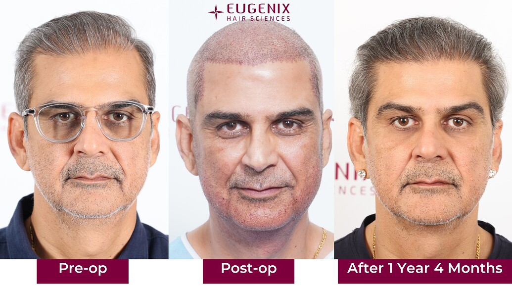 https://cdn.forumhairtransplant.com/optimized/3X/e/7/e7fff1d1783114fada937016dd7207fdc232b64c_2_1035x582.jpeg