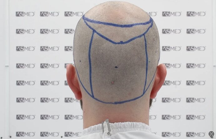 ASMED CLINIC CASE - DR.KORAY 5000 GRAFTS FUE photo