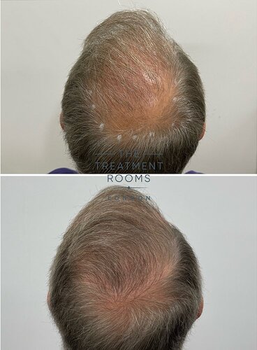 Crown Transplant - 2024 Grafts photo