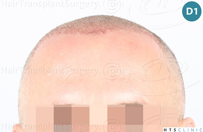 Dr Devroye + Dr Montesanti + Dr Jenard, HTS Clinic / 2932 FUE / Hairline & frontal area photo