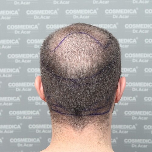 Cosmedica - 4000 Graft FUE Hair Transplant with Sapphire Blades. photo