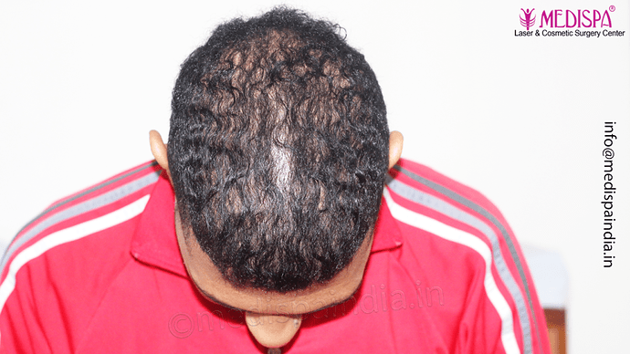 Dr. Suneet Soni - Afro Hair Transplant, 2 Sessions, 8355 Grafts, Combined FUT + FUE Technique, NW-VI, 5 Years Result photo