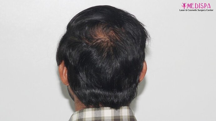 Revision Hair Transplant - 5111 Grafts / 5 Years Result - Dr. Suneet Soni, Medispa India photo