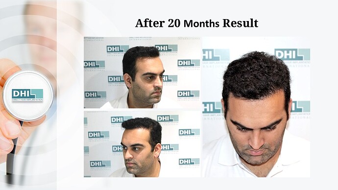 DHI India | NW 5 | 3,080 Grafts | 20-Months DHI Hair Transplant Results photo