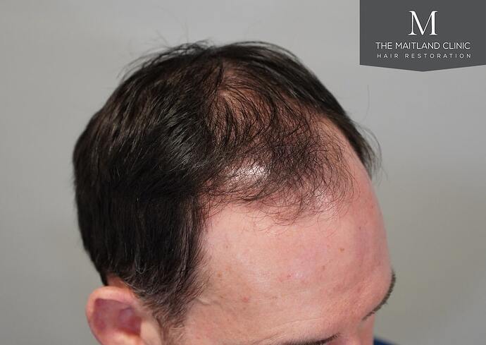 Dr Ball - The Maitland Clinic 1432 Grafts By FUE photo