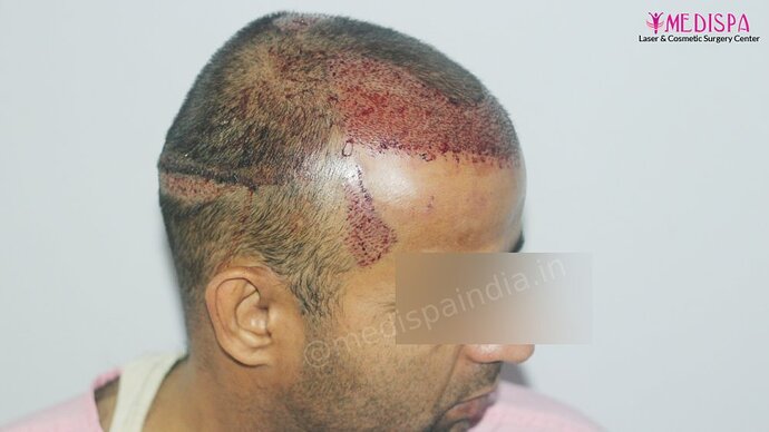 Dr. Suneet Soni - 4025 Grafts | 12-Month Result | Combination FUT + FUE photo
