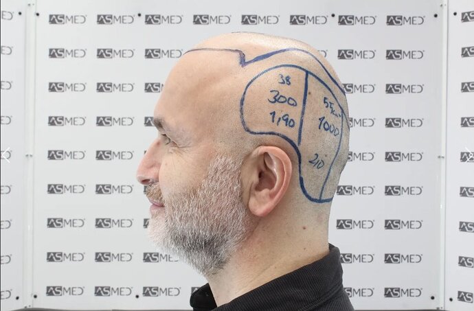 Asmed Clinic - FUE Hair Transplant - 5041 Grafts photo