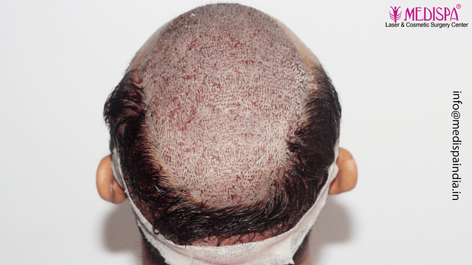 Dr. Suneet Soni - 4665 Grafts, Combine FUT + FUE + BHT (Beard) Technique photo