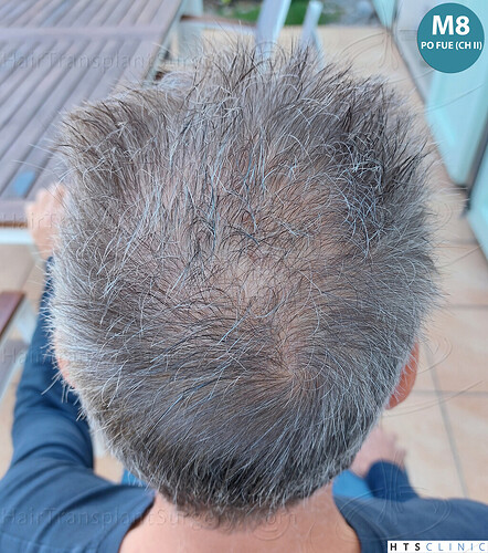 Dr Devroye + Dr Montesanti + Dr Jenard / 7015 grafts (4512 FUT + 2503 FUE) / 2 sessions photo