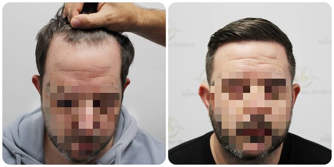 Dr Bonaros, Glasgow, UK / Receding Hairline Hair Transplant Result / 1446 FUE grafts / 0-12 Months photo