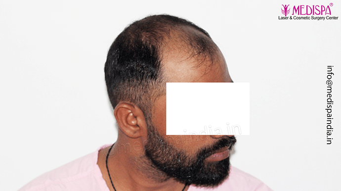 Dr. Suneet Soni - 5360 Grafts | 12-Month Result | Combination FUT + FUE + Beard photo