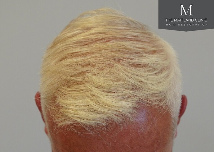 Dr Ball - The Maitland Clinic 2280 Grafts by FUE photo