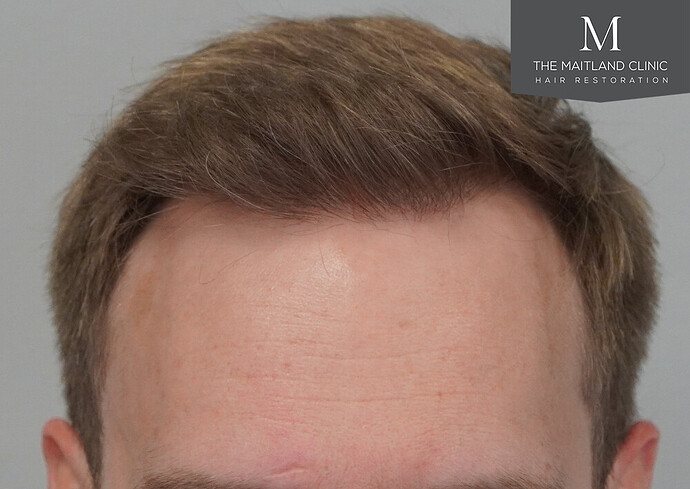 1826 grafts by FUE with Dr Edward Maitland Ball at The Maitland Clinic photo