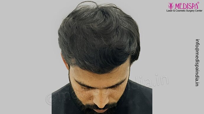 Dr. Suneet Soni - 3029 FUE Grafts, FUE Method (Trivellini System), NW - III photo