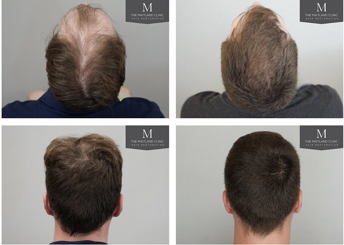 The Maitland Clinic - 2027 grafts by FUE photo