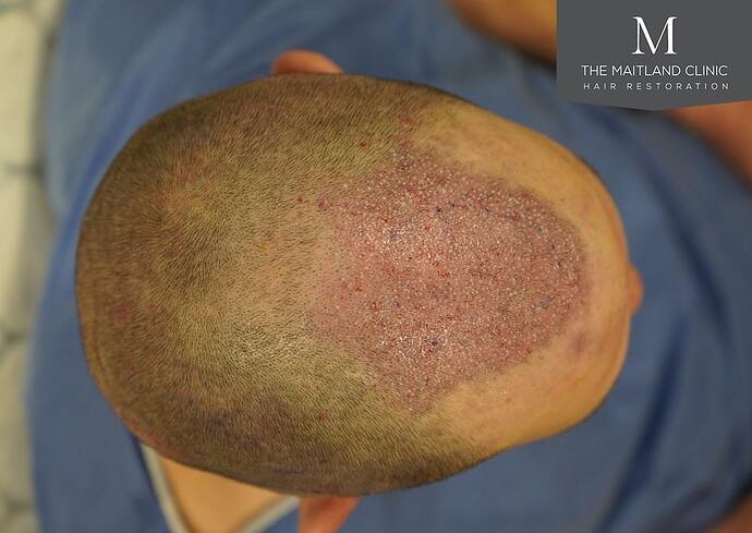 Dr Ball - The Maitland Clinic 1432 Grafts By FUE photo