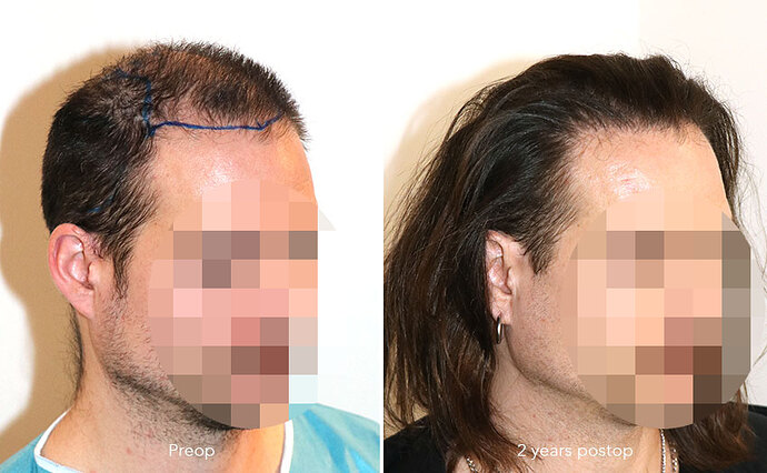 Case performed by Dr. Feriduni – 3346 FU in 1 procedure photo
