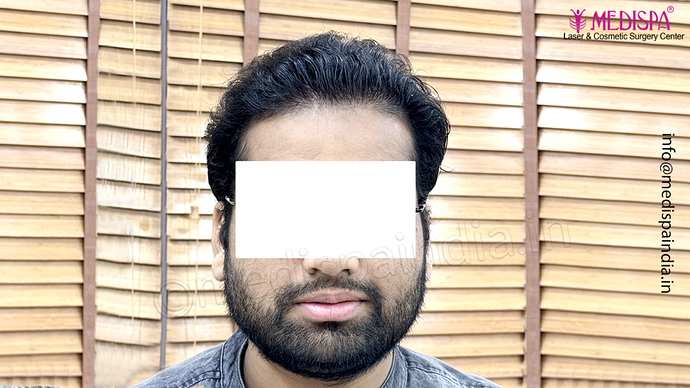 Dr. Suneet Soni - 5467 Grafts, Combine FUT + FUE + Beard Technique, NW- V, 3 Years Result photo