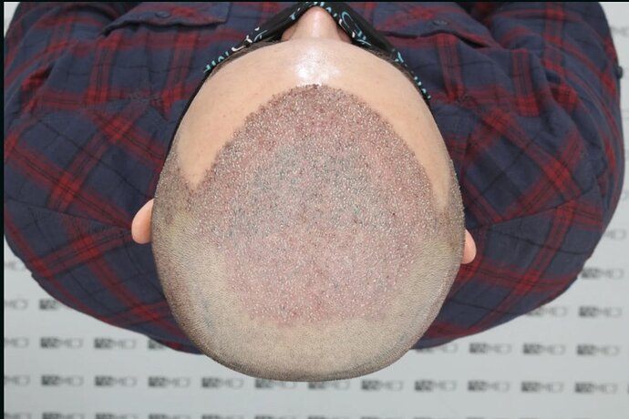 ASMED CLINIC - DR.KORAY - 5060 GRAFTS FUE photo