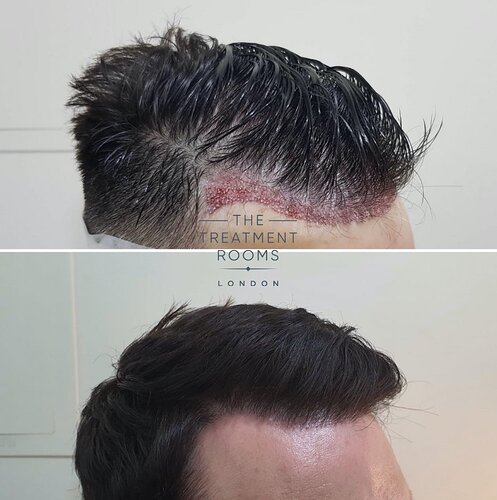 Hairline FUE hair transplant surgery photo