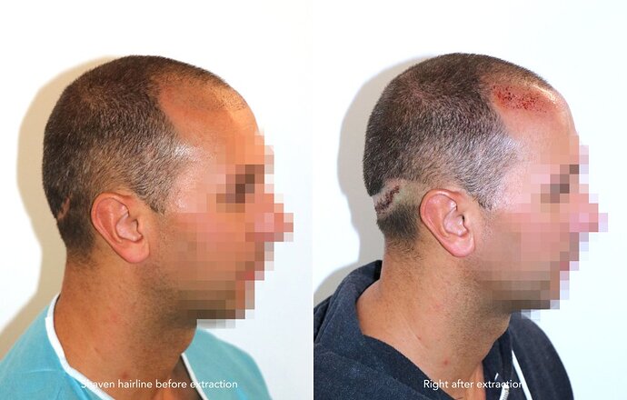 Repair case performed by Dr. Feriduni – 708 FU in 1 procedure photo