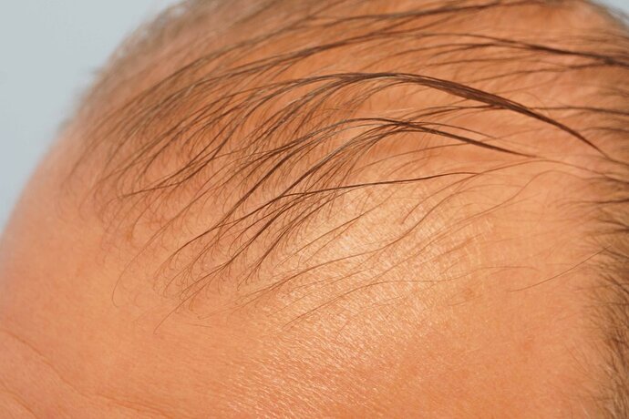 Dr B Farjo 1700g FUE (Front) photo