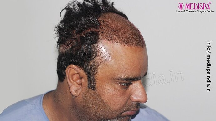 Dr. Suneet Soni - 4500 Grafts, 3 Year Result, NW-IV, Combine FUT + FUE Technique photo