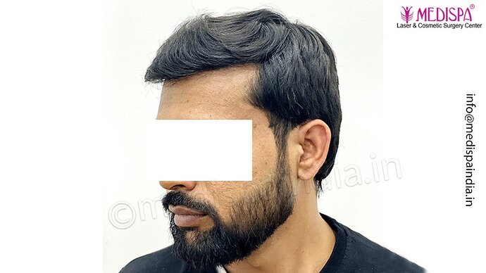 Dr. Suneet Soni - 3029 FUE Grafts, FUE Method (Trivellini System), NW - III photo