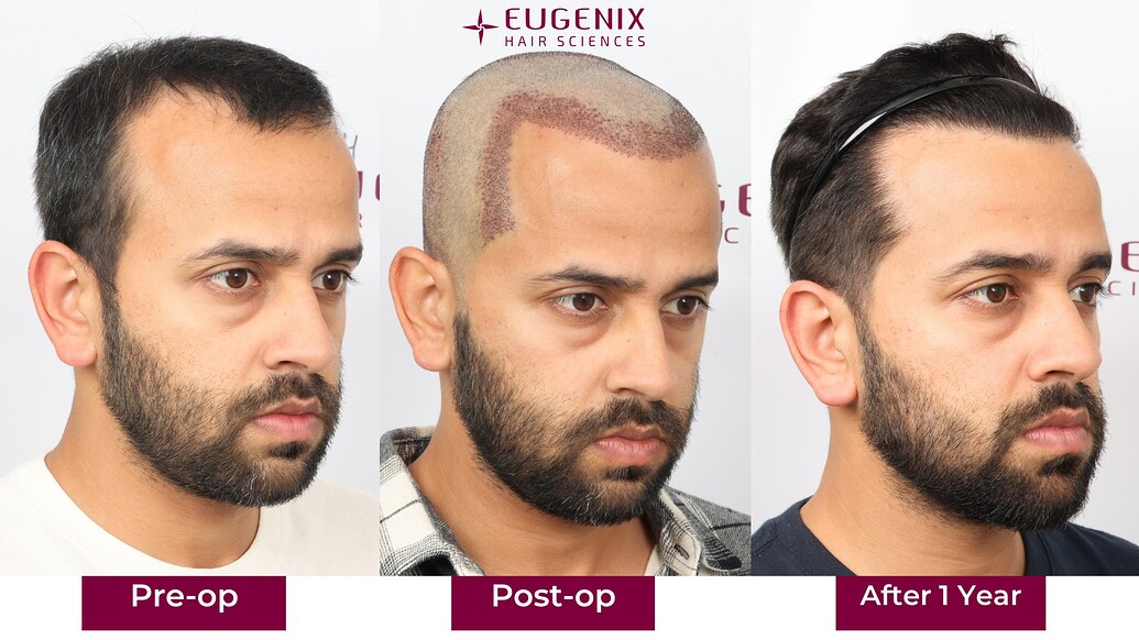 https://cdn.forumhairtransplant.com/optimized/3X/e/b/eb7db78b635bbdf1f56f0ad030ea3453115c94e1_2_1035x582.jpeg