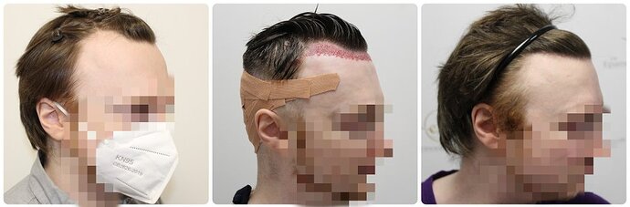 Dr Bonaros, Glasgow, UK / 1614 FUE grafts for receding Hairline / 0-12 Months photo