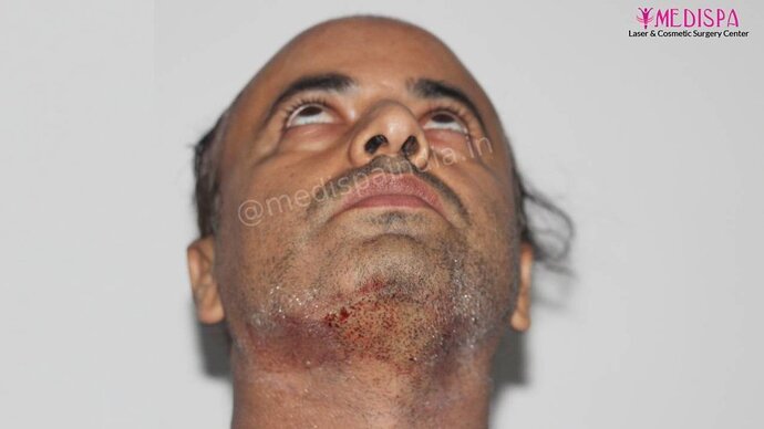 11600 Grafts in 3 FUT Sittings by Dr Suneet Soni photo