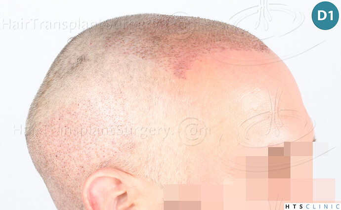 Dr Devroye + Dr Montesanti + Dr Jenard, HTS Clinic / 2932 FUE / Hairline & frontal area photo